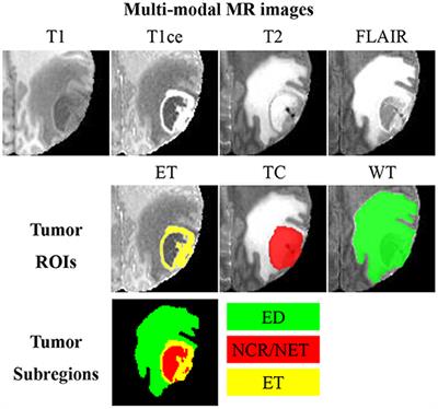 Frontiers | Brain Tumor Segmentation From Multi-Modal MR Images Via ...